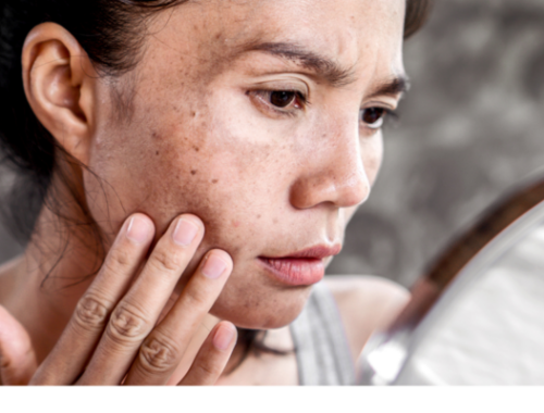 Nám da là tình trạng tăng sắc tố melanin, thường xuất hiện thành mảng nâu trên gò má, trán hoặc quanh miệng. 