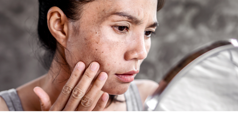 Nám da là tình trạng tăng sắc tố melanin, thường xuất hiện thành mảng nâu trên gò má, trán hoặc quanh miệng. 