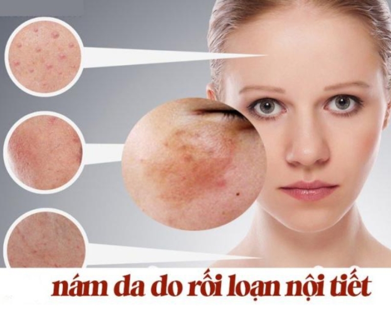 Ánh nắng, rối loạn nội tiết, stress và chăm sóc da sai cách là những nguyên nhân phổ biến gây nám. 