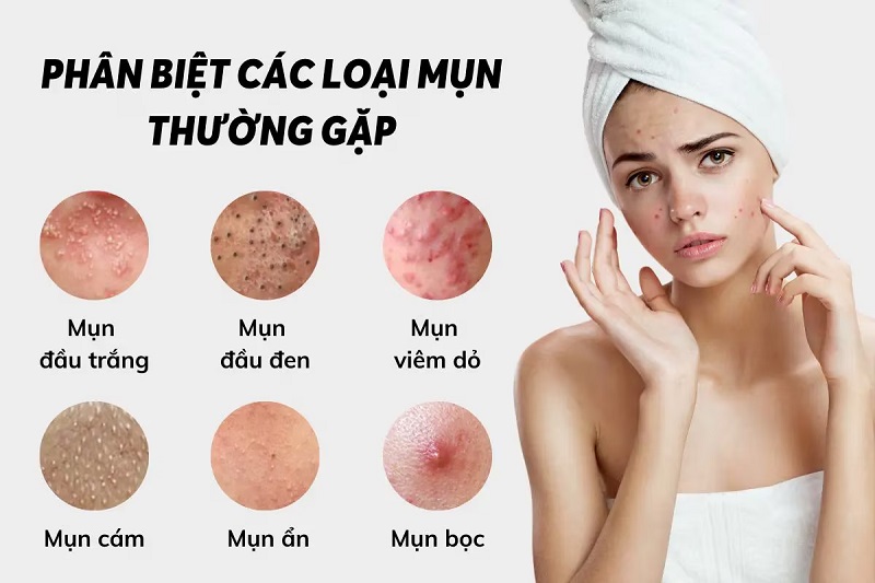 Mỗi loại mụn có đặc điểm khác nhau, vì vậy cần nhận biết đúng trước khi chăm sóc da. 