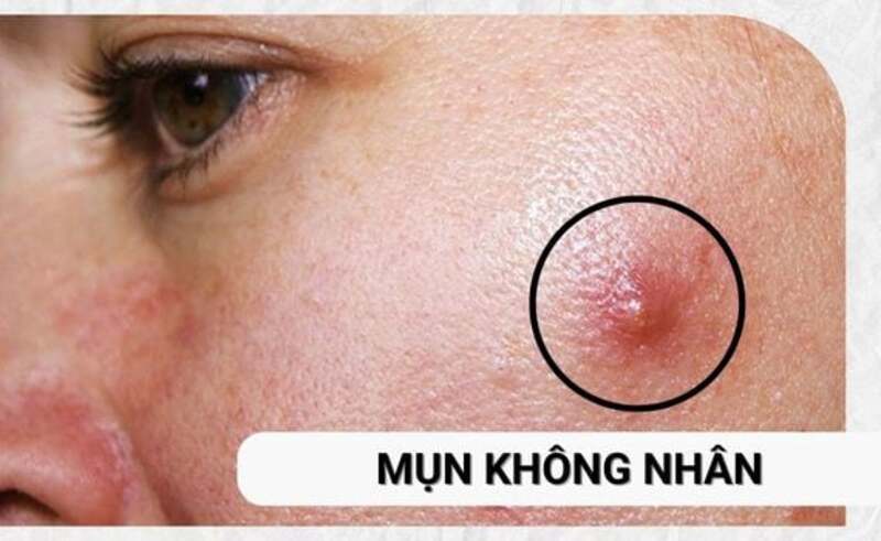 Mụn không nhân không nên tự nặn, mà cần chăm sóc nhẹ nhàng để giảm sưng và hạn chế viêm lan rộng. 