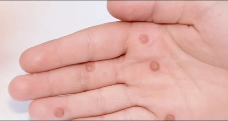 Mụn cóc thường có dạng nốt sần thô ráp, mọc đơn lẻ hoặc thành cụm trên da.