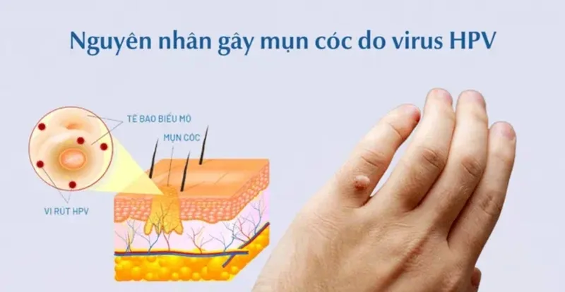 Mụn cóc thường do virus HPV xâm nhập qua các vết trầy xước nhỏ trên da và có thể lan sang vùng da khác.