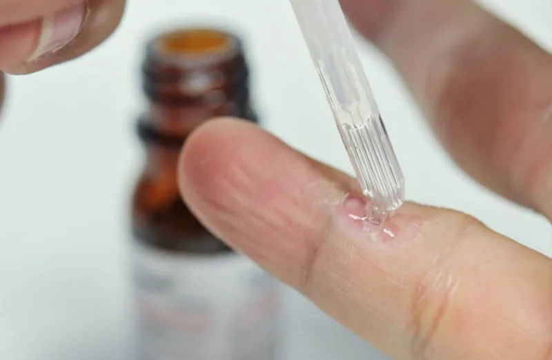 Khi dùng salicylic acid, cần bôi đúng vị trí mụn cóc và tránh để thuốc lan sang vùng da lành xung quanh.
