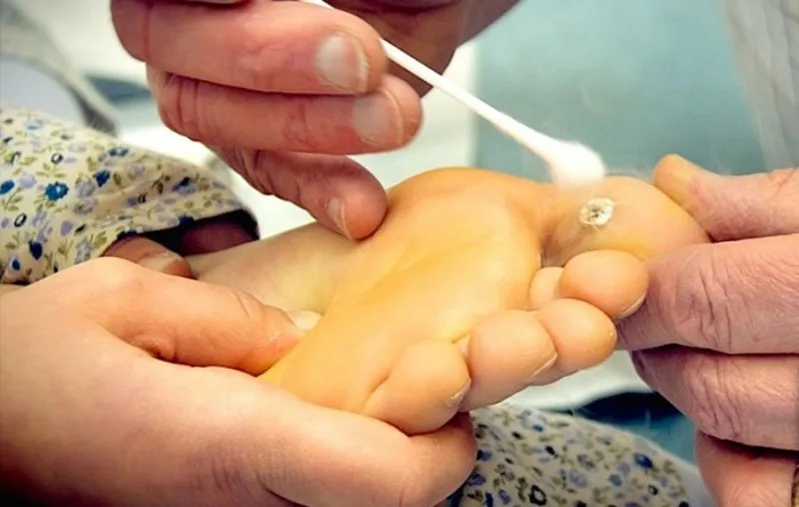 Mụn cóc ở vùng nhạy cảm, đổi màu hoặc gây đau kéo dài là dấu hiệu cần được bác sĩ kiểm tra.